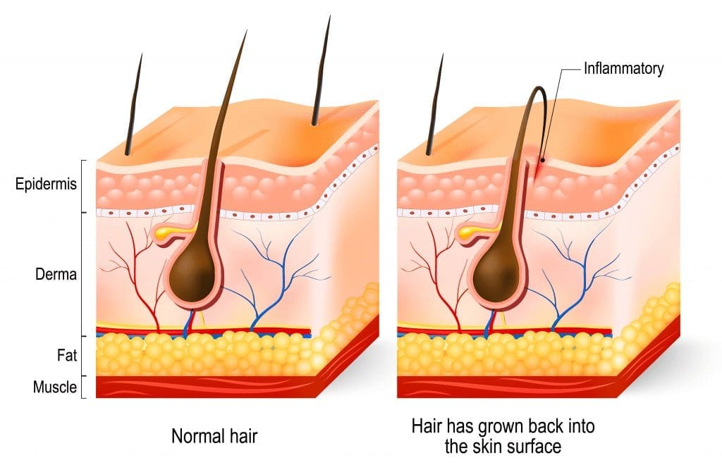 Illustration of Ingrown Hair, does laser hair removal work for ingrown hairs? Ingrown Hair Removal Near Me - Laser Hair Removal for Ingrown Hairs - Treating Ingrown Hairs with Laser - Treat Ingrown Hairs - Laser Ingrown Hair Removal - Laser Hair Removal for Ingrown Hairs