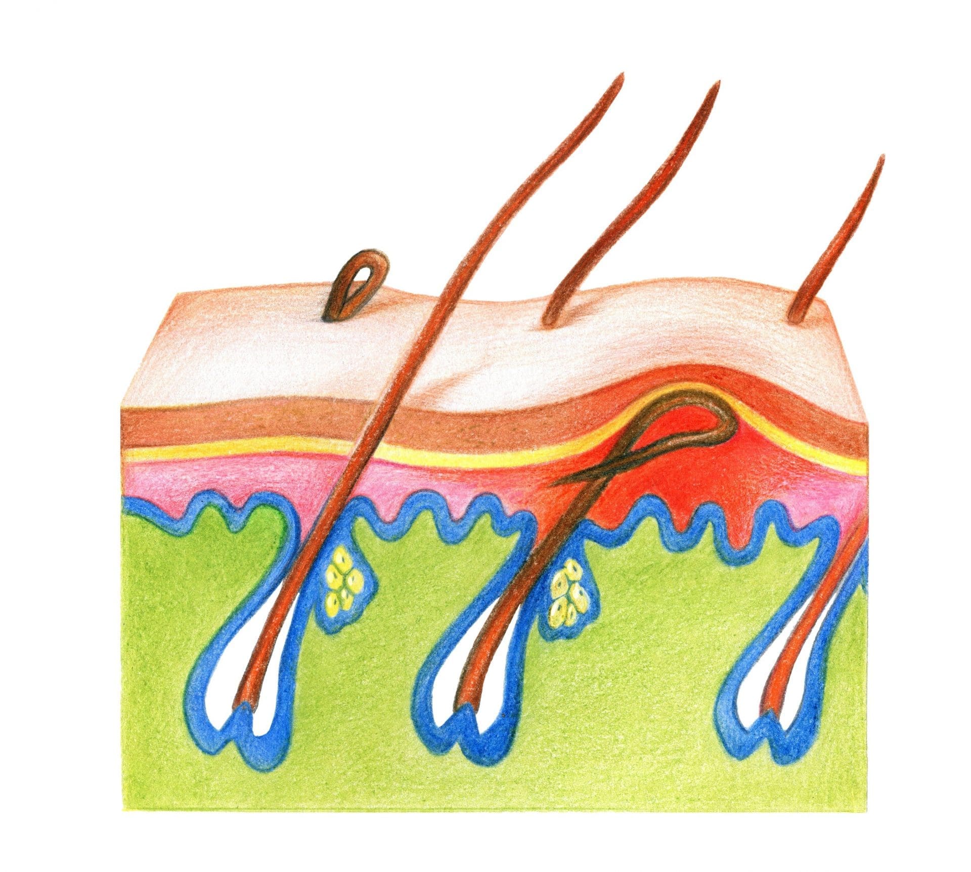 Illustration of Ingrown Hair, does laser hair removal work for ingrown hairs? Ingrown Hair Removal Near Me - Laser Hair Removal for Ingrown Hairs - Treating Ingrown Hairs with Laser - Treat Ingrown Hairs - Laser Ingrown Hair Removal - Laser Hair Removal for Ingrown Hairs