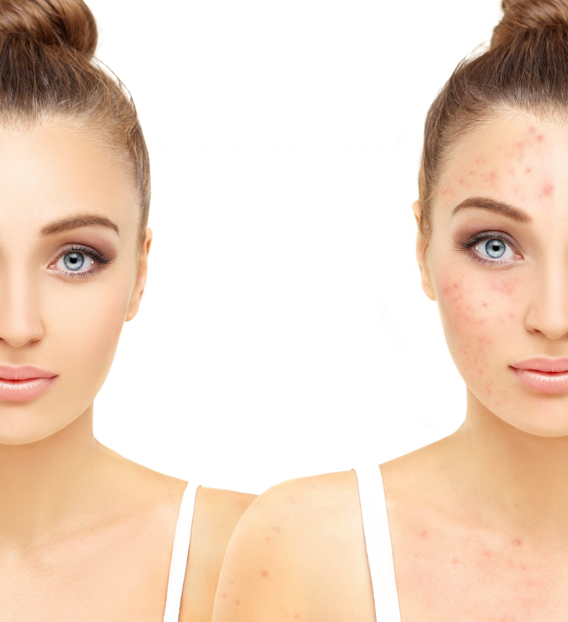 Laser Skin Treatments - Acne Treatment