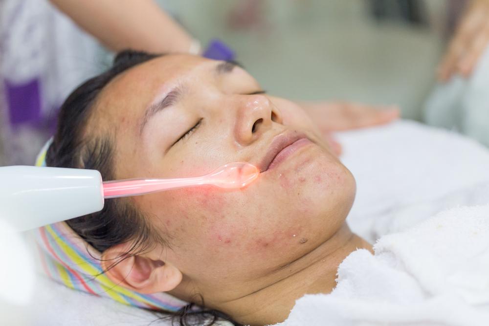 Acne Laser Treatment