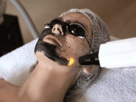 Laser Carbon Peeling Facial